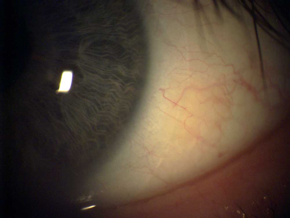 Die Precision1 Tageslinse aus dem Hause Alcon hat eine äußerst dünnes Randprofil und ist daher besonders angenehm zu tragen. Spaltlampenuntersuchung in Ingolstadt bei Optik Schönauer (ehemals Optik Reichhart).