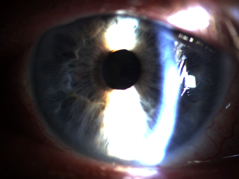 Gesundes Auge transparent nach Grauer Star OP